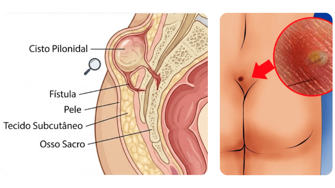 Tratamento de Cisto Pilonidal a Laser