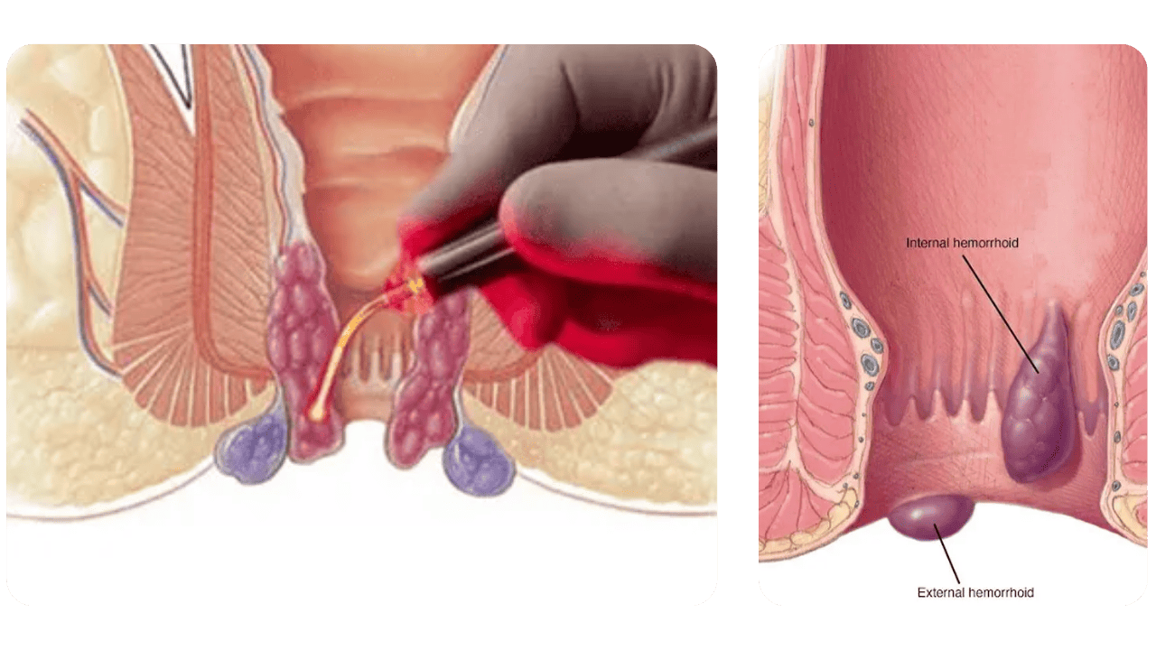O Uso do Laser no Tratamento de Hemorróidas e Fissuras Anais