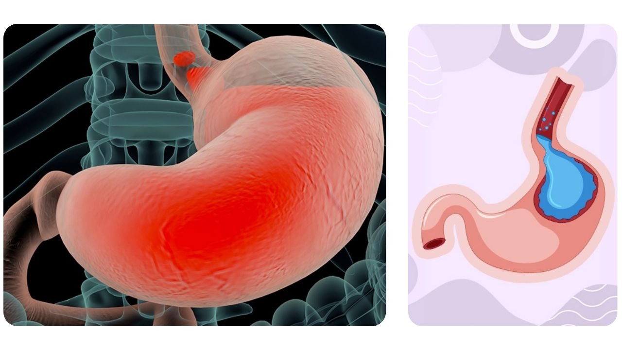 Doença do Refluxo (DRGE)