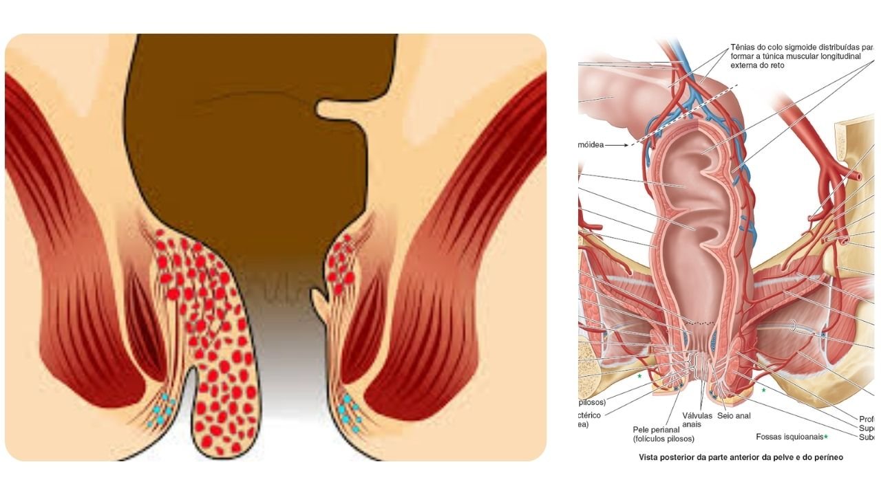 Fissura Anal e o Ciclo da Dor