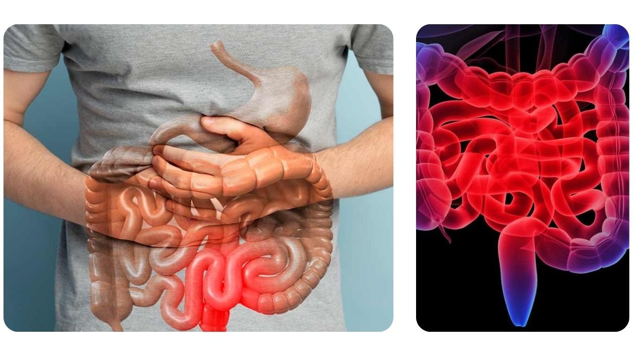 Intestino Preso: Muito Além do Desconforto Abdominal