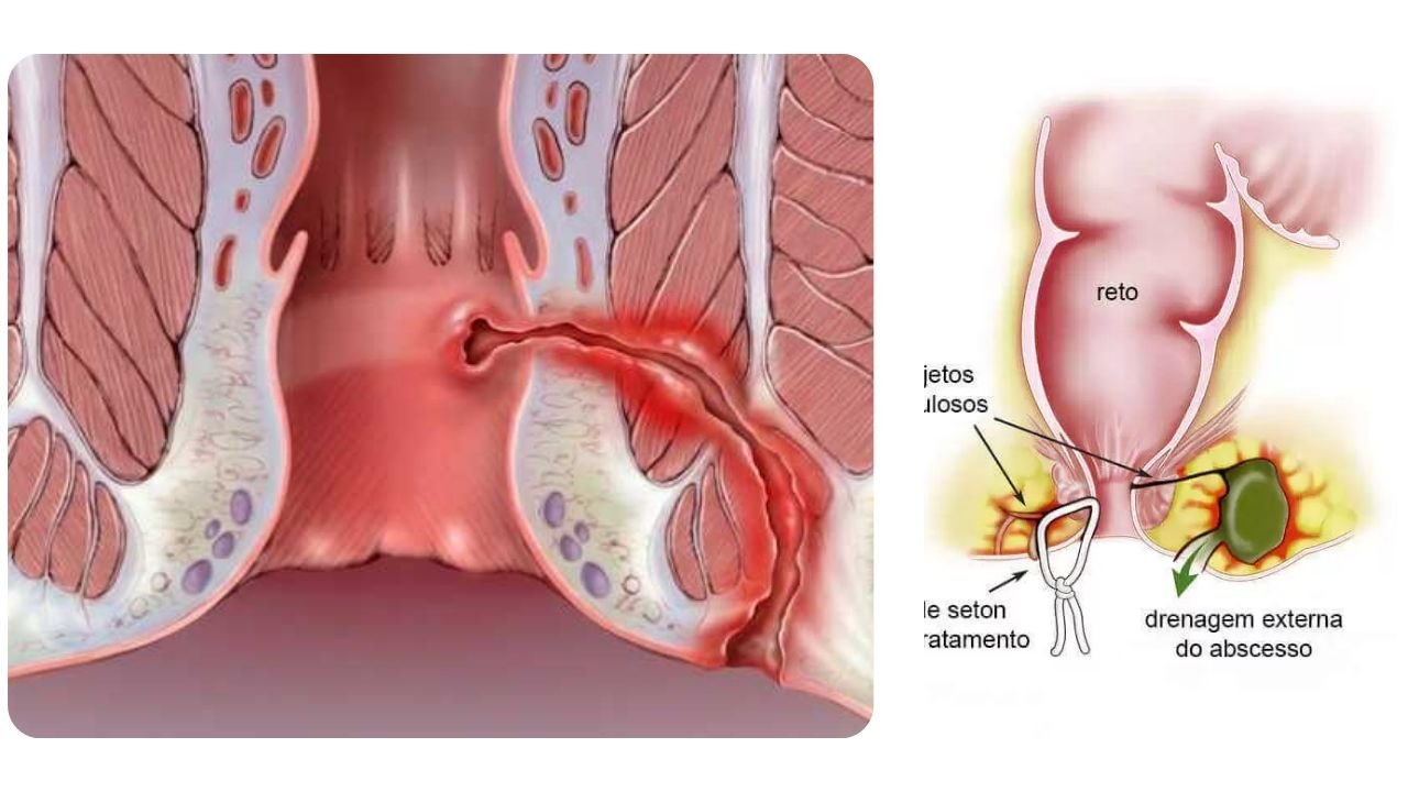 Fístula Anal