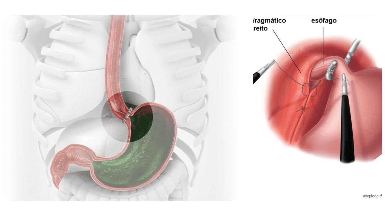 Cirurgia do Refluxo Gastroesofágico